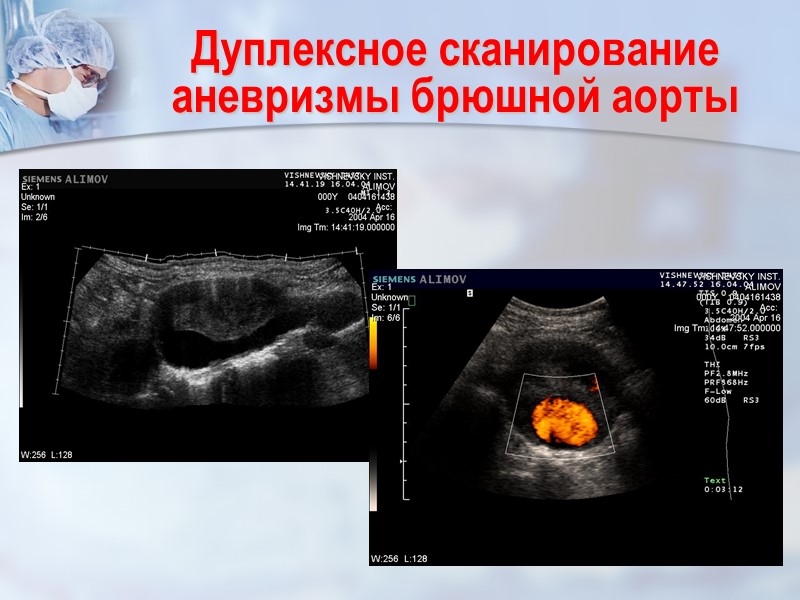 Дуплексное сканирование аневризмы брюшной аорты